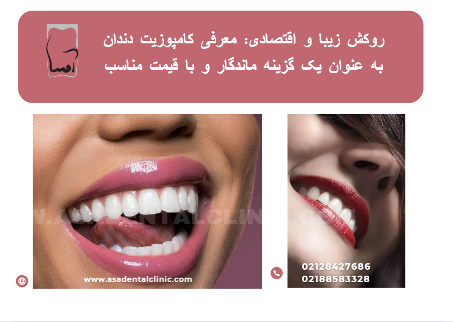مزایای استفاده از کامپوزیت دندان