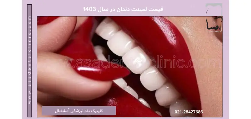 قیمت لمینت دندان در سال 1403