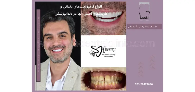 انواع کامپوزیت‌های دندانی و کاربردهای اصلی آنها در دندانپزشکی