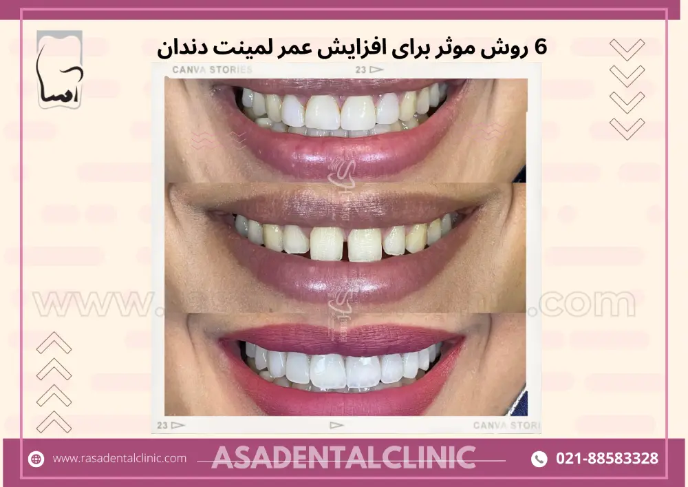 6 روش موثر برای افزایش عمر لمینت دندان