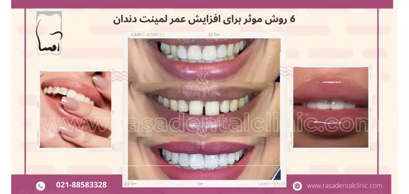 6 روش موثر برای افزایش عمر لمینت دندان