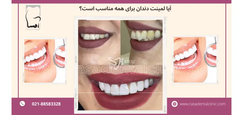 آیا لمینت دندان برای همه مناسب است؟ بررسی شرایط پزشکی و دندانی مورد نیاز