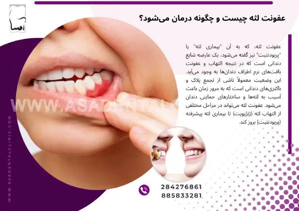 عفونت لثه چیست و چگونه درمان می‌شود؟