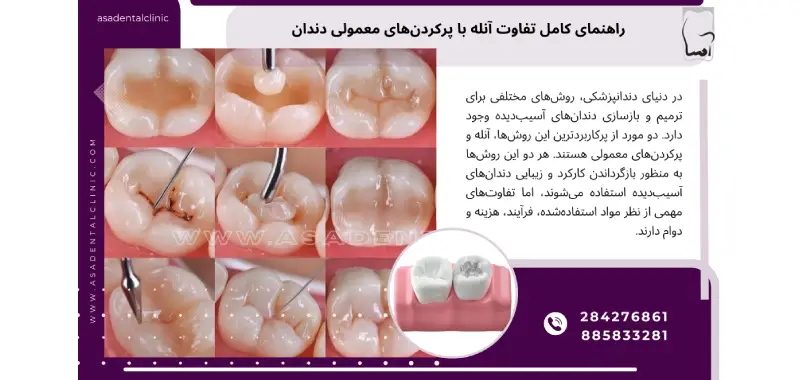 راهنمای کامل تفاوت آنله با پرکردن‌های معمولی دندان