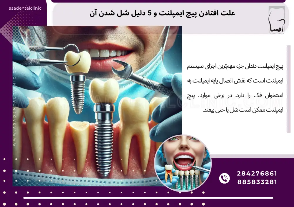 علت افتادن پیچ ایمپلنت و 5 دلیل شل شدن آن