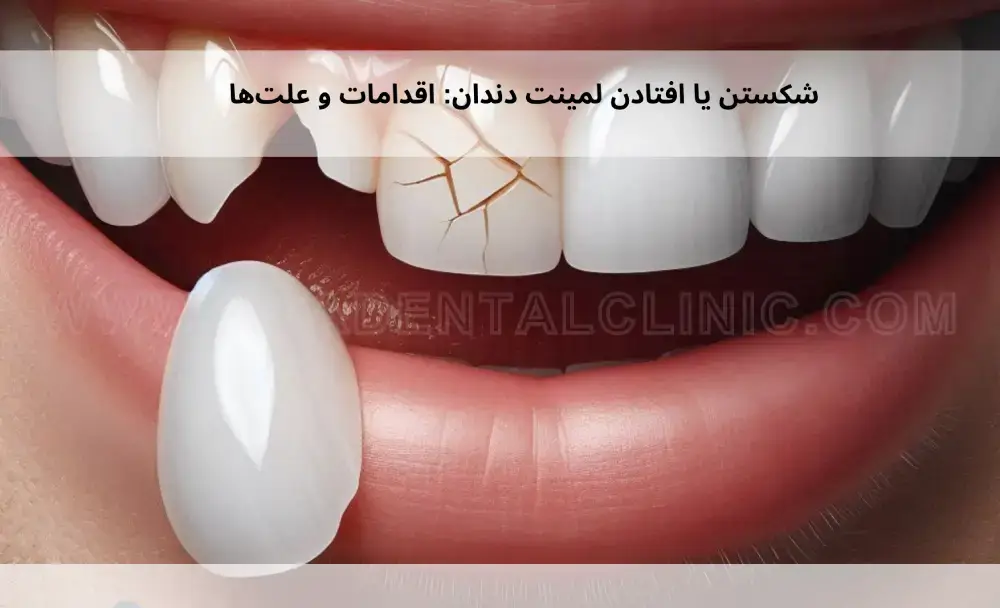 Dental-laminate-breaks-or-falls-off_-measures-and-causes-1 شکستن یا افتادن لمینت دندان: اقدامات و علتها