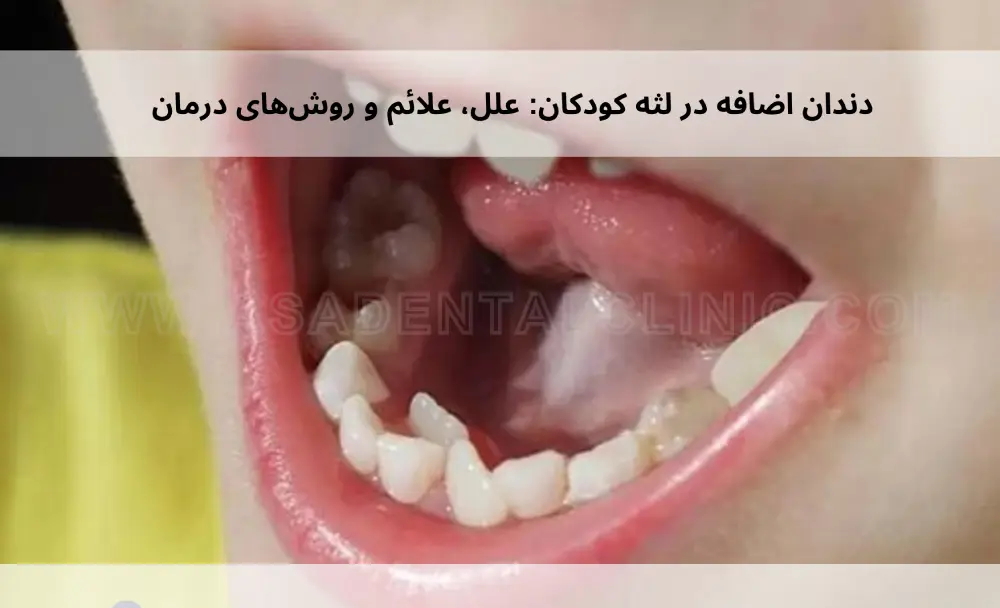 Extra-teeth-in-childrens-gums-1 دندان اضافه در لثه کودکان: علل، علائم و روشهای درمان