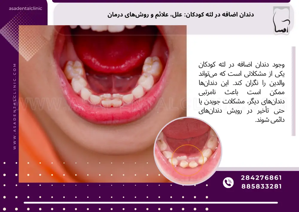دندان اضافه در لثه کودکان: علل، علائم و روش‌های درمان