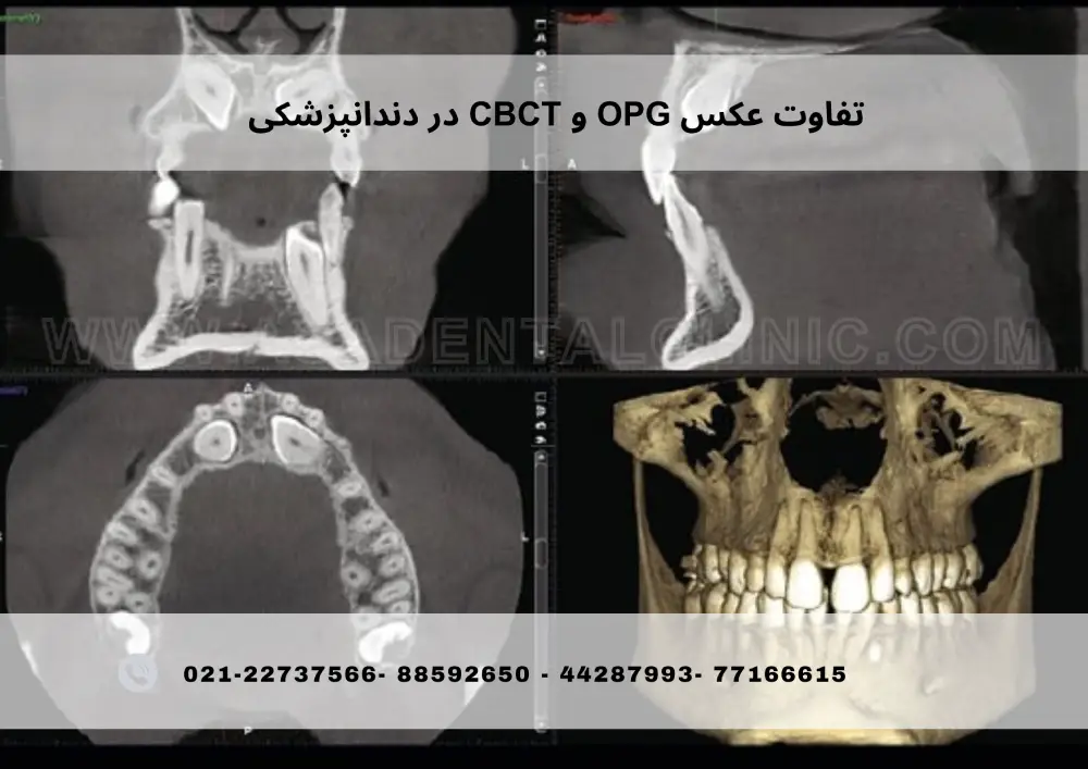 تفاوت عکس OPG و CBCT در دندانپزشکی