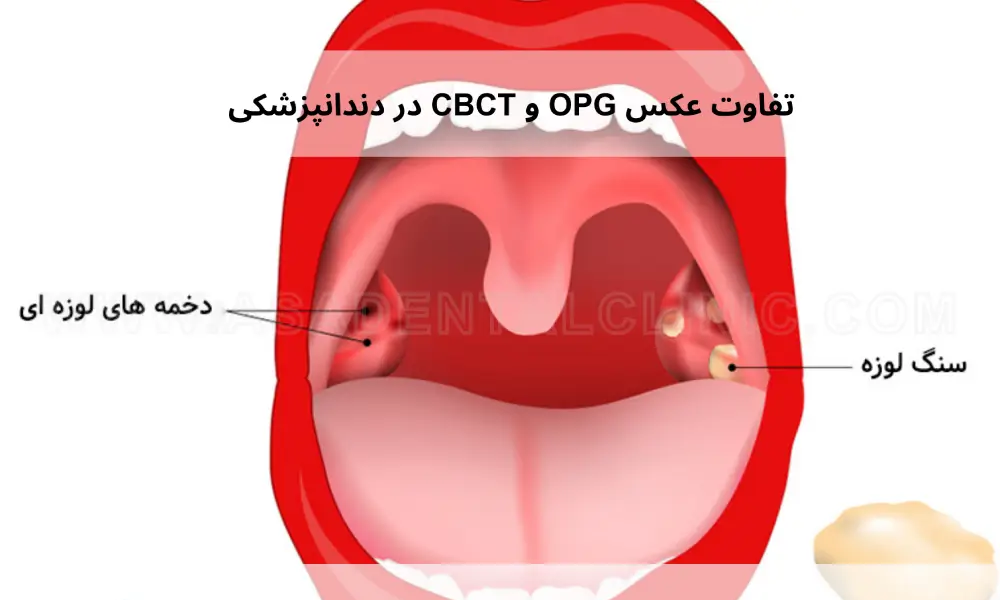 Treating-Tonsil-Stones-with-Mouthwash_-Understanding-This-Problem-and-Treatment-Methods- سنگ لوزه چیست؟