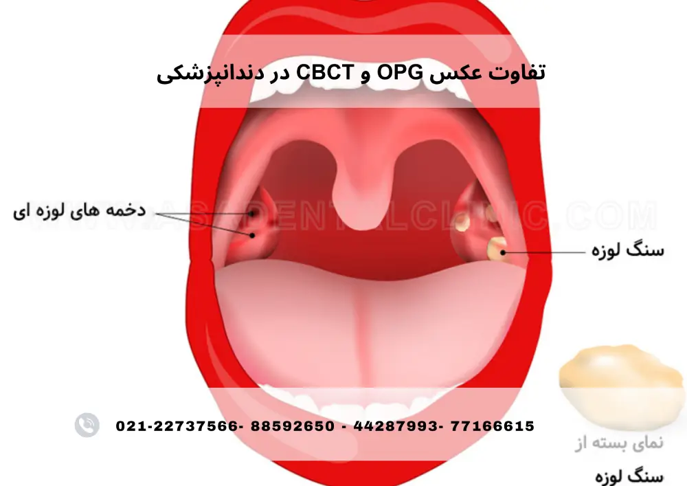 سنگ لوزه چیست؟