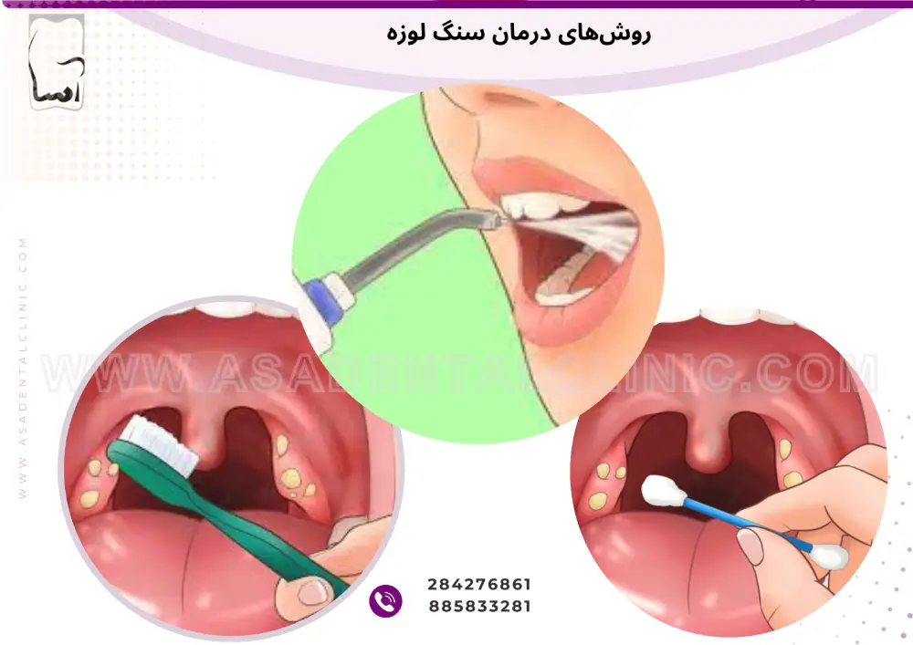 روش‌های درمان سنگ لوزه