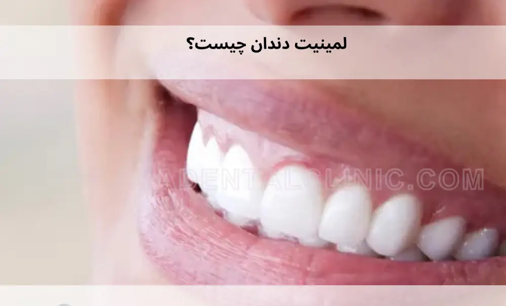 Everything-about-dental-lamination-1 همه چیز درباره لمینیت دندان