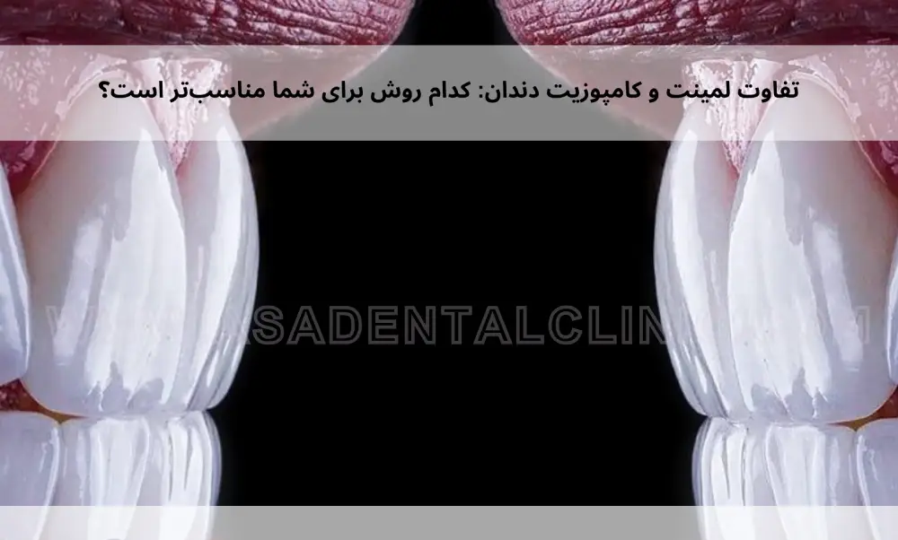 The-difference-between-dental-laminate-and-composite-1 تفاوت لمینت و کامپوزیت دندان