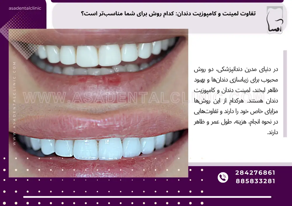 تفاوت لمینت و کامپوزیت دندان
