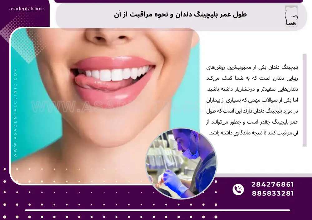 طول عمر بلیچینگ دندان و نحوه مراقبت از آن