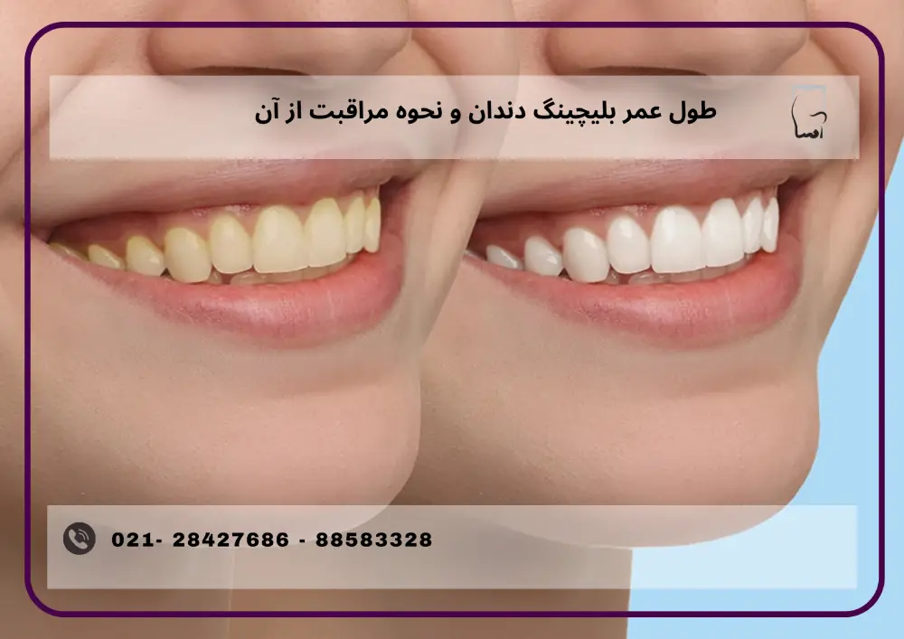 طول عمر بلیچینگ دندان و نحوه مراقبت از آن طول عمر بلیچینگ دندان و نحوه مراقبت از آن