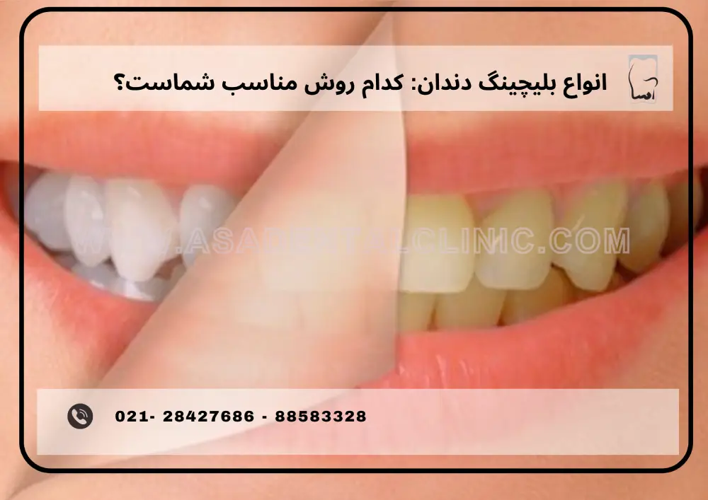2 (6) انواع بلیچینگ دندان