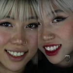 بلیچینگ دندان