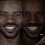 بلیچینگ دندان