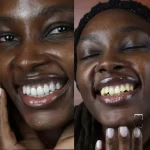 بلیچینگ دندان