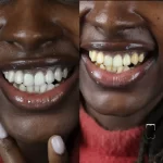 بلیچینگ دندان