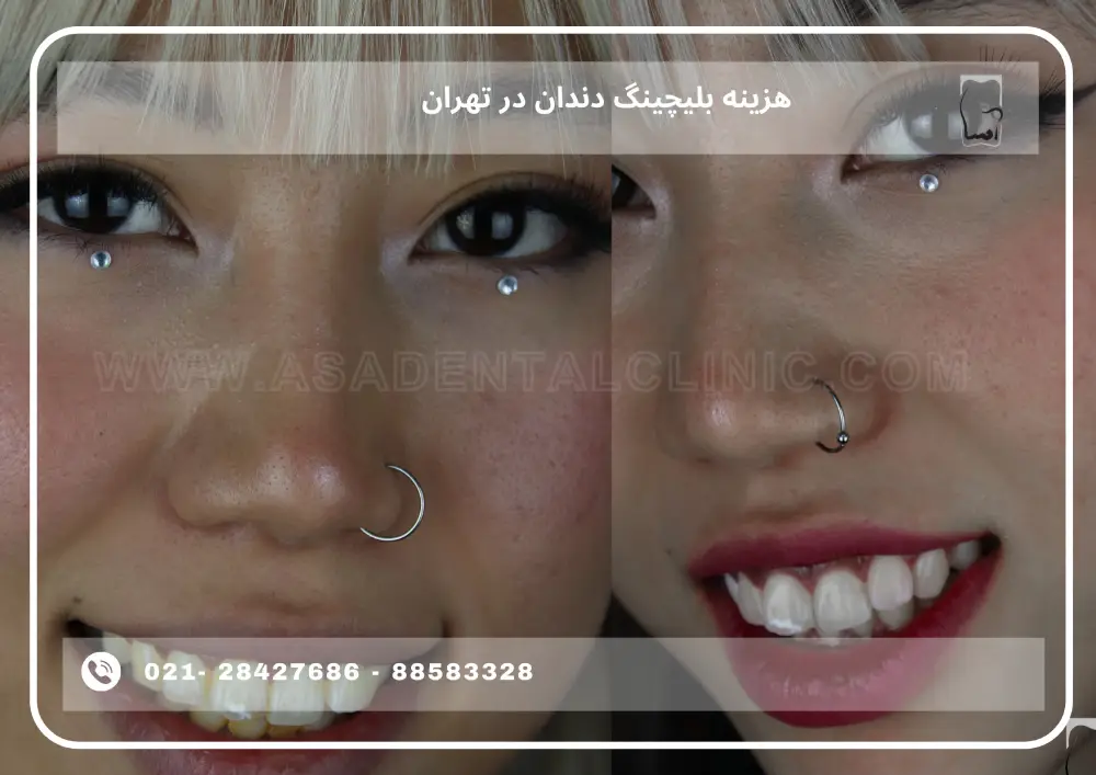 Cost of teeth bleaching in Tehran (1) هزینه بلیچینگ دندان در تهران