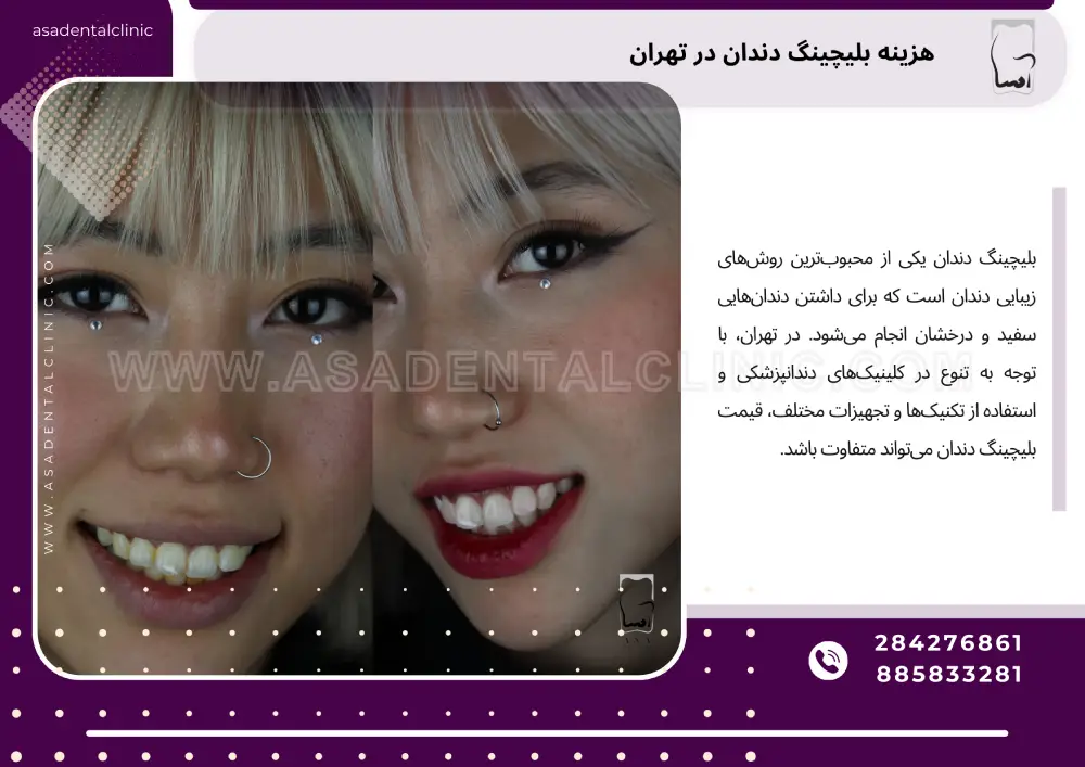 هزینه بلیچینگ دندان در تهران