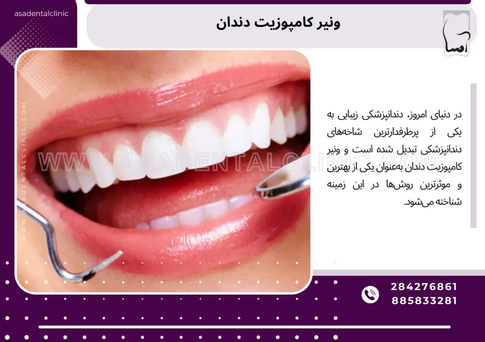 ونیر کامپوزیت دندان