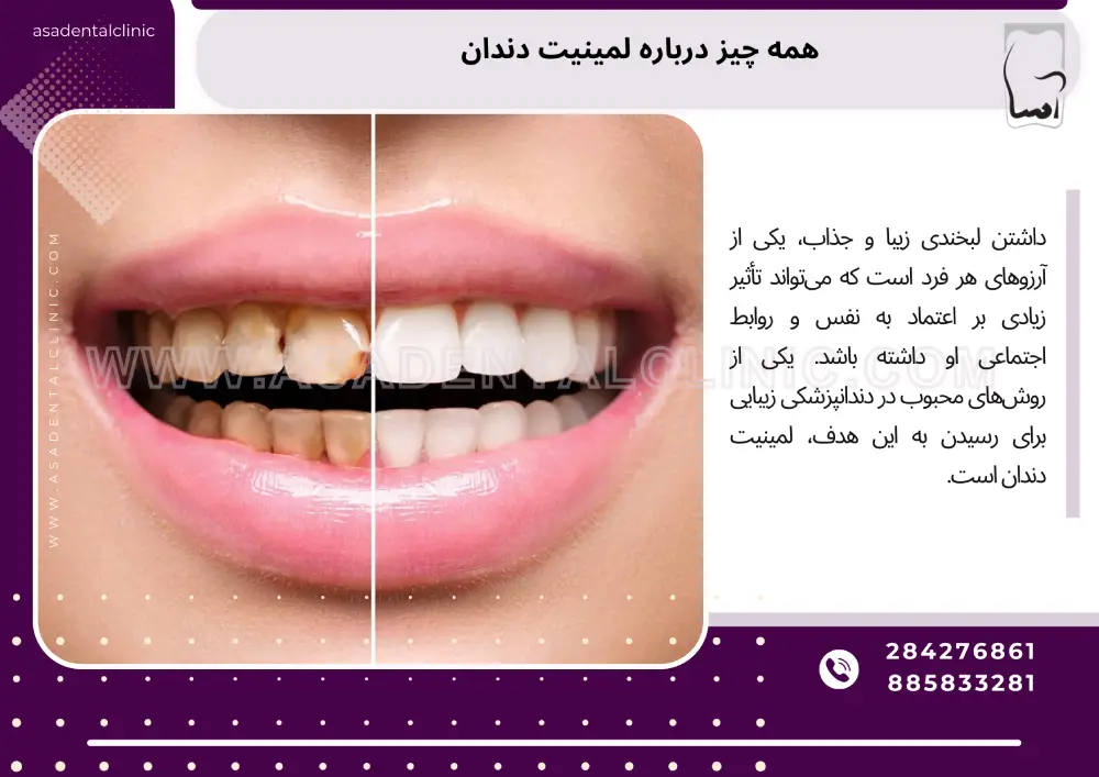 همه چیز درباره لمینیت دندان
