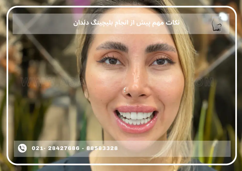 Important points before teeth bleaching (1) نکات مهم پیش از انجام بلیچینگ دندان