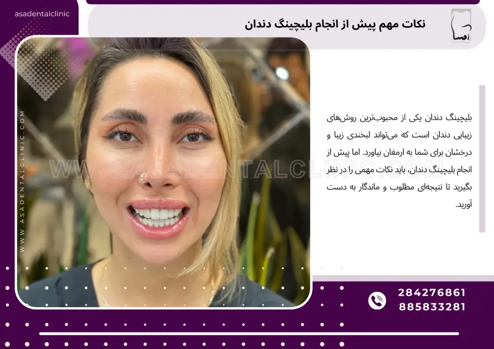 نکات مهم پیش از انجام بلیچینگ دندان