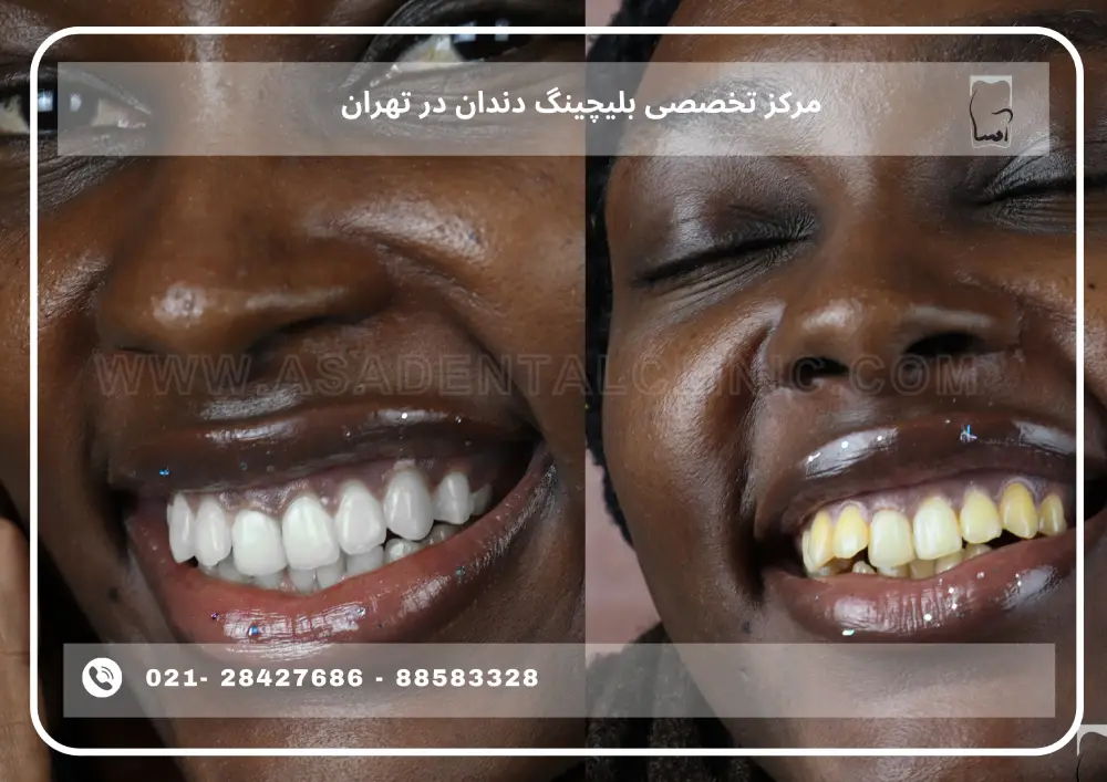 Specialized teeth bleaching center in Tehran (1) مرکز تخصصی بلیچینگ دندان در تهران
