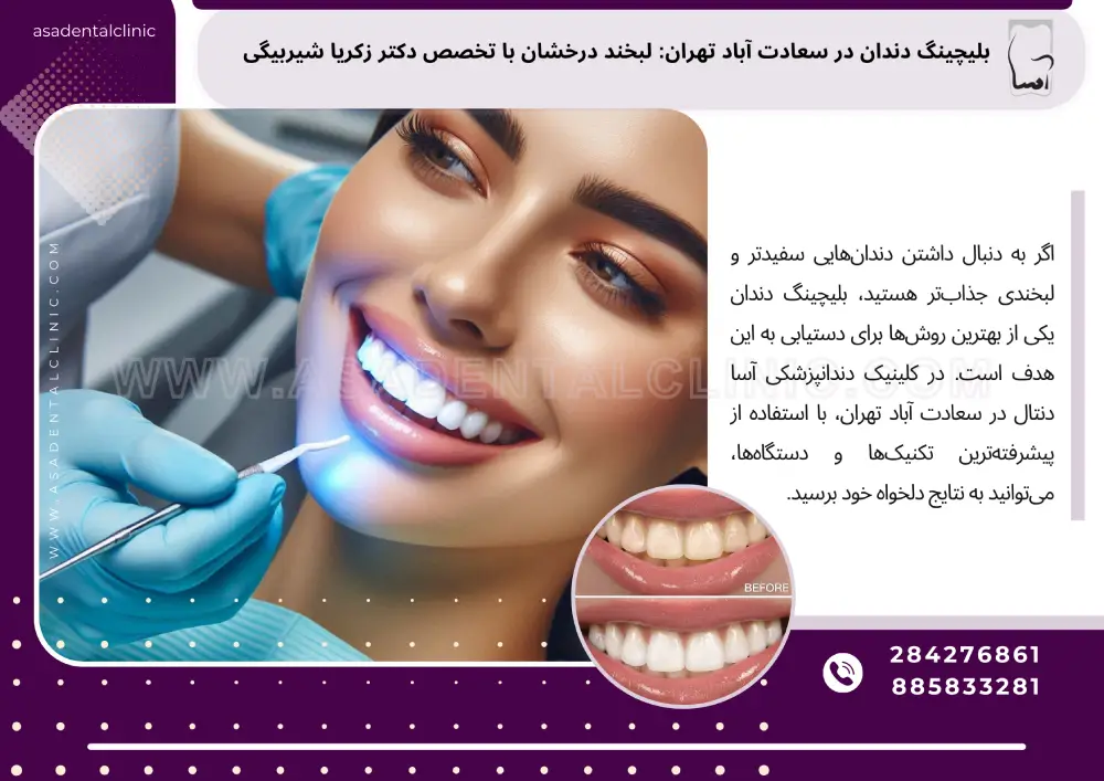 بلیچینگ دندان در سعادت آباد تهران