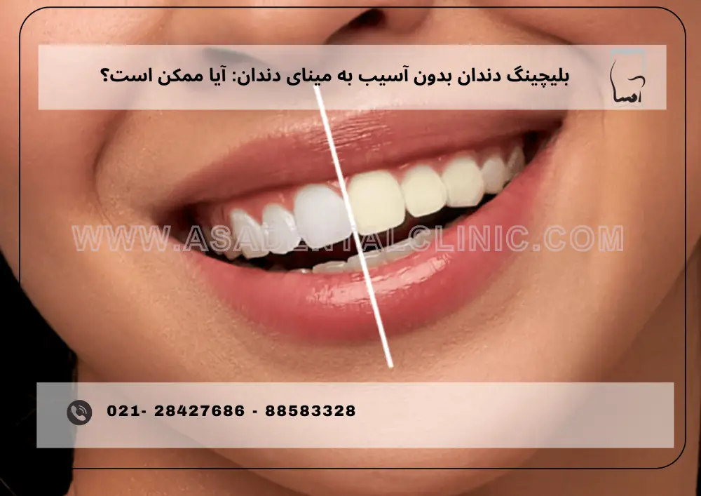 Teeth bleaching without damaging tooth enamel (1) بلیچینگ دندان بدون آسیب به مینای دندان: آیا ممکن است؟