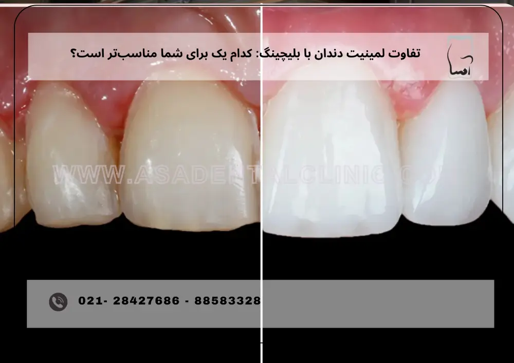 The difference between tooth lamination and bleaching (1) تفاوت لمینیت دندان با بلیچینگ
