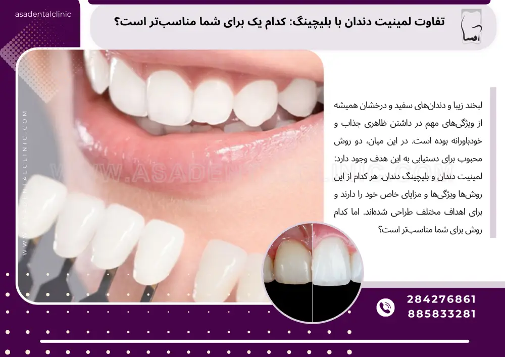 تفاوت لمینیت دندان با بلیچینگ
