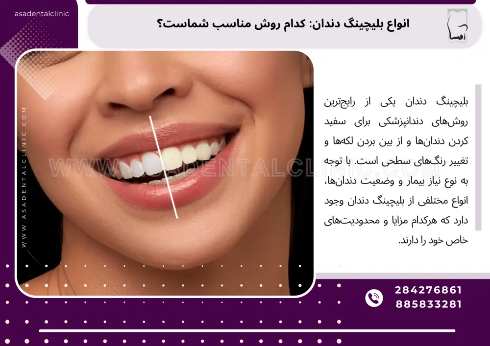 انواع بلیچینگ دندان: کدام روش مناسب شماست؟