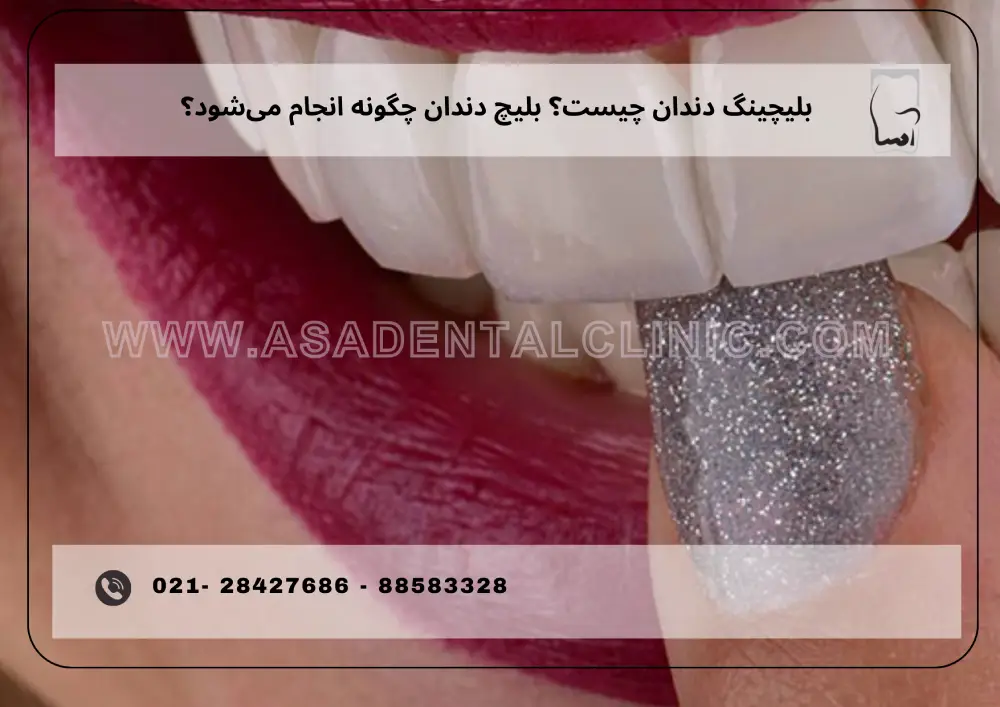 What is teeth bleaching_ (1) بلیچینگ دندان چیست؟ بلیچ دندان چگونه انجام میشود؟