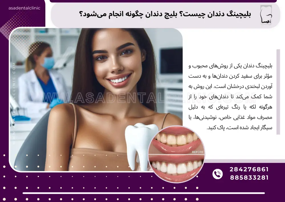 بلیچینگ دندان چیست؟ بلیچ دندان چگونه انجام می‌شود؟