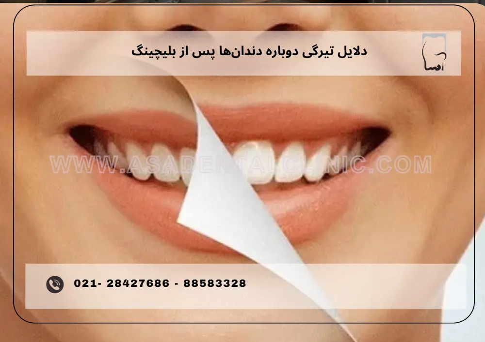 Why do your teeth get dark again after bleaching_ (1) دلایل تیرگی دوباره دندانها پس از بلیچینگ