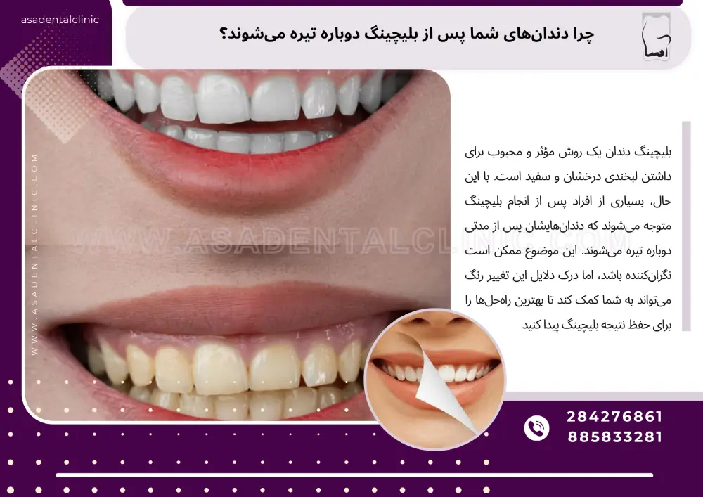 دلایل تیرگی دوباره دندان‌ها پس از بلیچینگ