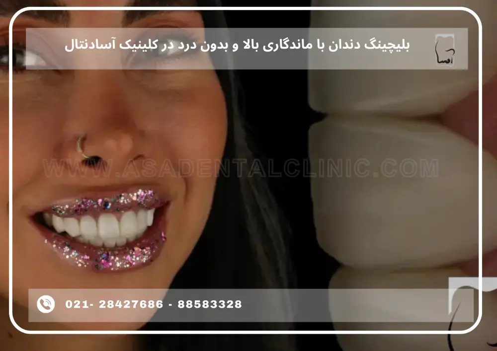 1 لیچینگ دندان با ماندگاری بالا و بدون درد در کلینیک آسادنتال