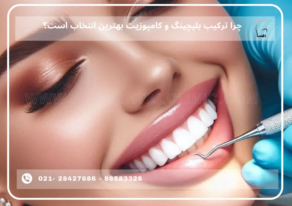 Combination of bleaching and composite (1) ترکیب بلیچینگ و کامپوزیت