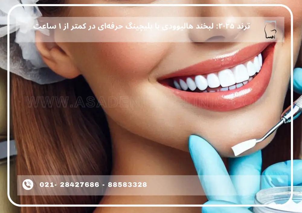 Hollywood smile with professional bleaching (1) لبخند هالیوودی با بلیچینگ حرفهای