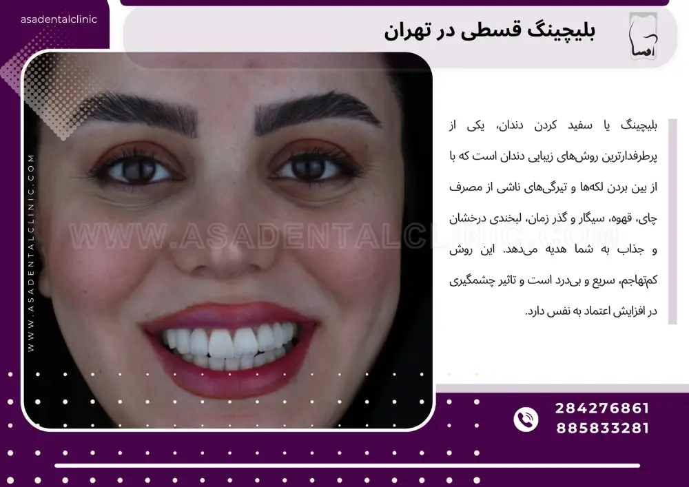 Installment bleaching in Tehran