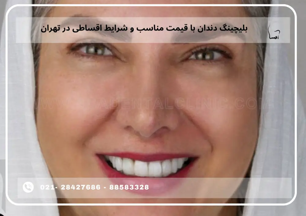 Teeth whitening at an affordable price (1) بلیچینگ دندان با قیمت مناسب و شرایط اقساطی در تهران
