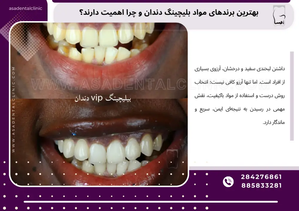 The best brands of teeth whitening materials بهترین برندهای مواد بلیچینگ دندان