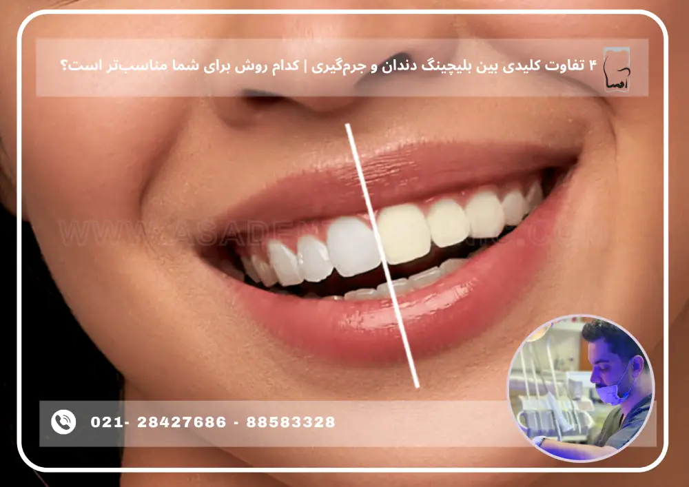 The difference between bleaching and descaling (1) ۴ تفاوت کلیدی بین بلیچینگ دندان و جرمگیری