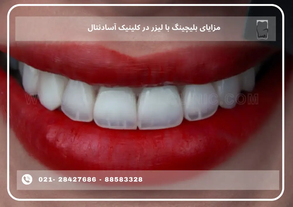 Laser teeth bleaching in Tehran (1) مزایای بلیچینگ با لیزر در کلینیک آسادنتال